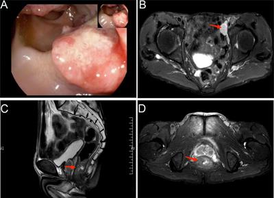 Synchronous multiple primary cancers involving rectal cancer and pelvic classical hodgkin lymphoma: the first case report